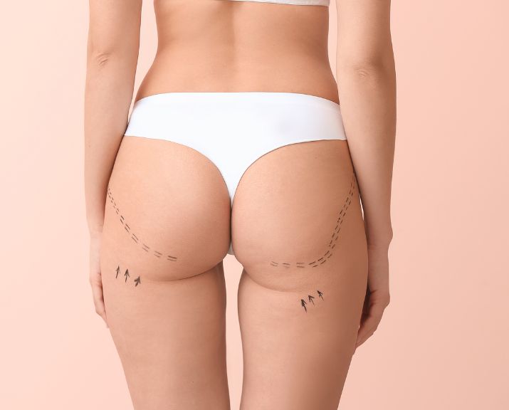celulitis piernas, tratamiento celulitis, como quitar el celulitis medico estetico medicina estetica